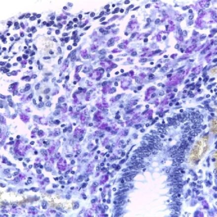 Швидкий кислотний тест на бактерії за Цилем- Нільсеном модифікований за Файтом набір барвників  250 тестів