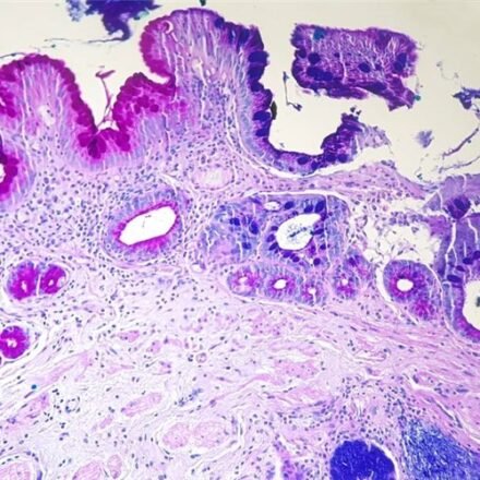 Альциановий блакитний pH 2,5 за Моурі 100 тестів