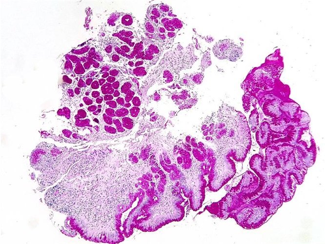 P.A.S. (перйодна кислота Шиффа) за Хочкіссом-МакМанусом набір барвників 100 тестів