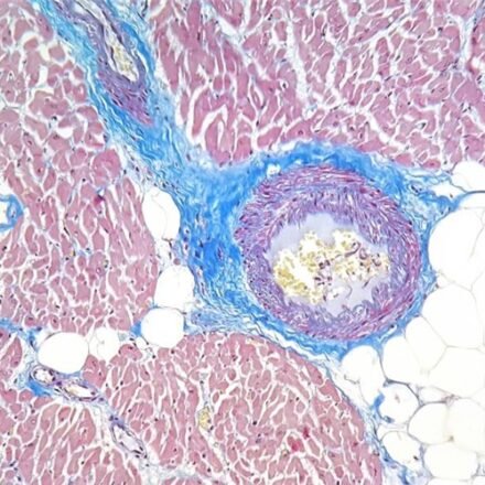 Пікро Маллорі трихром набір барвників 250 тестів