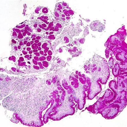 Хромотроп аніліновий блакитний (CAB) набір барвників 1000 тестів